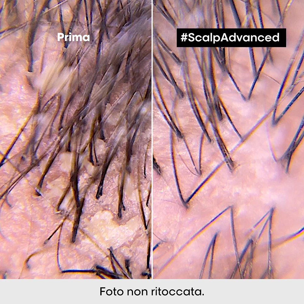 L'oreal Professionnel Scalp Advanced Anti-Dandruff 300 ml - Image 4
